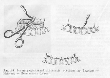 Operațiunea de operație pe gingie cu parodontită înainte și după
