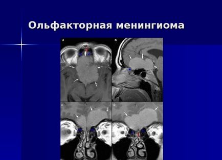 Менінгіома головного мозку - що це таке