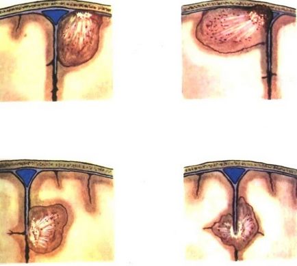 Meningiomul creierului - ce este?