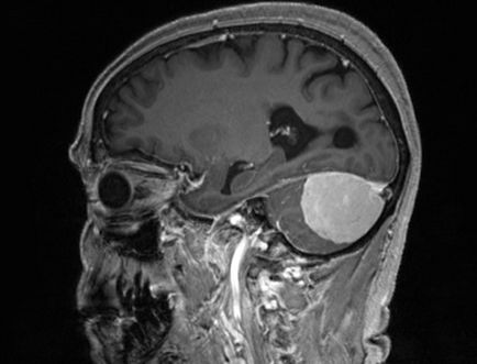 Meningiomul creierului - ce este?