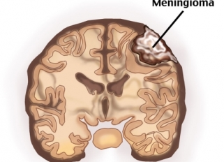 Meningióma tünetek, a kezelés, a diagnózis és a tünetek agyi meningióma