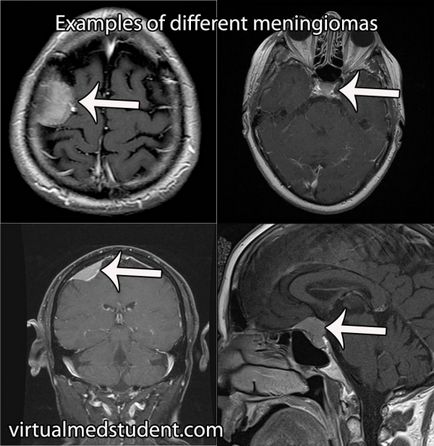 Meningióma tünetek, a kezelés, a diagnózis és a tünetek agyi meningióma