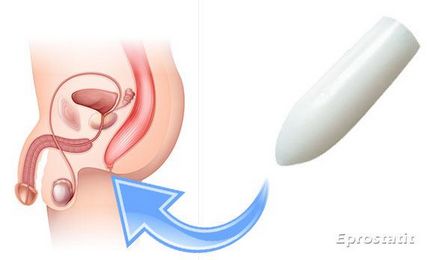 Supozitoarele metyluracilice cu prostatită - cât de eficiente sunt acestea