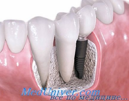 Методи фіксації імплантатів зубів гвинтова фіксація і фіксація на цемент