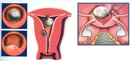 Myomul uterului de dimensiuni mici, cum să-l tratați și dacă se poate dizolva