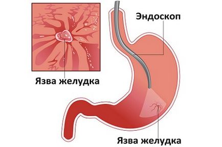 Lapte în ulcer gastric ce să vă temeți și cum să luați