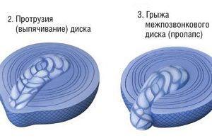 Чи може розсмоктатися міжхребцева грижа