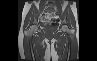 MRI a kismedencei szervek - ár, árfolyam, dekódolás, előkészítése, ellenjavallatok