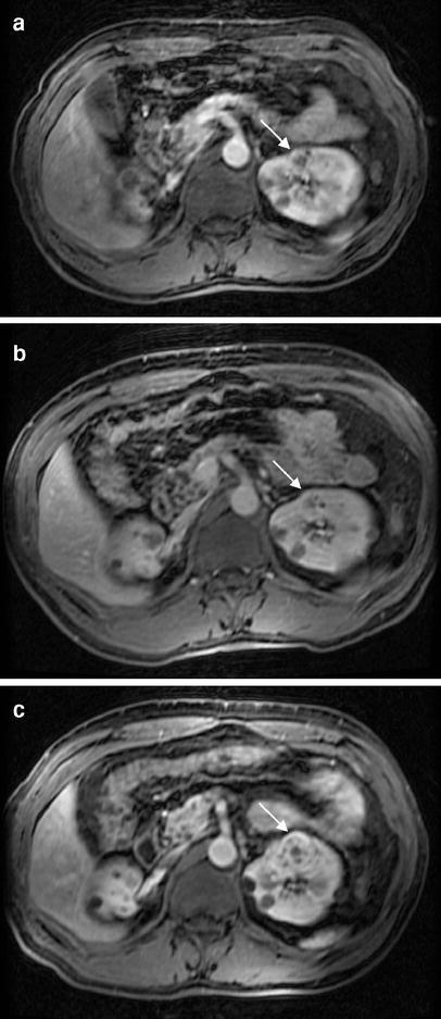 MRI renális (vese) vese MRI