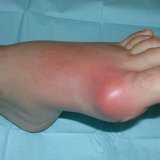 Народні методи лікування кісточки на ногах - скальпель - медичний інформаційно-освітній