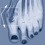 Metode tradiționale de tratare a pietrei pe picioare - bisturiu - informație medicală-educativă