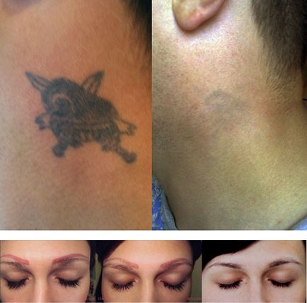 Laserul neodim în îndepărtarea părului cosmetologic, îndepărtarea tatuajelor și a cicatricilor, întinerire