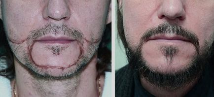 Нерівномірне зростання бороди що робити якщо порожньо на щоках або зростання помітний тільки з одного боку