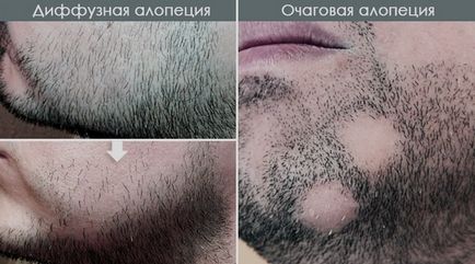 Нерівномірне зростання бороди що робити якщо порожньо на щоках або зростання помітний тільки з одного боку