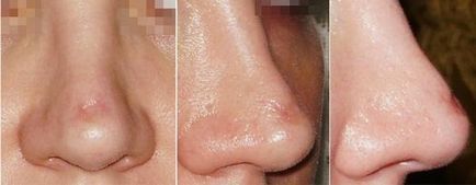 Невдала ринопластика (пластика носа) - фото до і після, відгуки