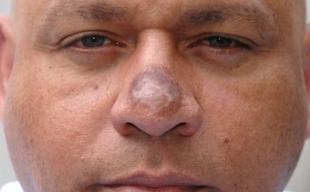 Rinoplastie nereușită (nas plastic) - înainte și după fotografii, recenzii