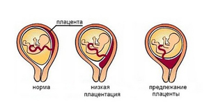 Placenta scăzută în timpul sarcinii, 20 săptămâni de cauză și riscurile asociate