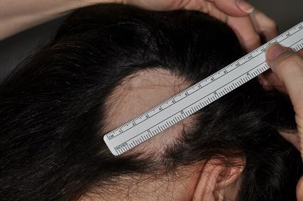 Metodele dovedite de Alopecia areata și posibilele erori de tratament