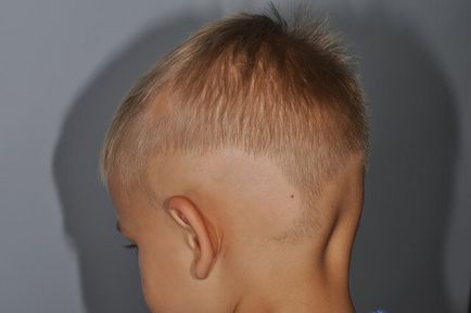 Metodele dovedite de Alopecia areata și posibilele erori de tratament