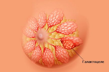 Oncologia glandelor mamare la femei