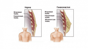 Операція з видалення гінекомастії у чоловіків, лікування до і після операції пластичними хірургами