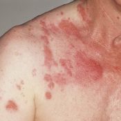 Herpes zoster (a szemkörnyék) övsömör