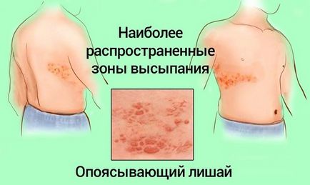 Herpes zoster (övsömör) övsömör