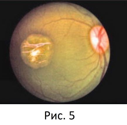 Оптичне управління рефрактогенеза і гомеостазом очі