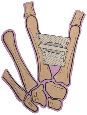 Ortopédiai és sebészeti kezelés összehúzódások és deformitások gyerekek bénulás - ortopédiai sebészet