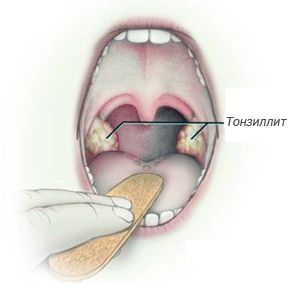 Гострий і хронічний тонзиліт як проявляються і чим небезпечні