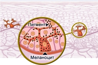 Від чого з'являються пігментні плями на шкірі тіла і обличчя, причини пігментації шкіри рук і ніг