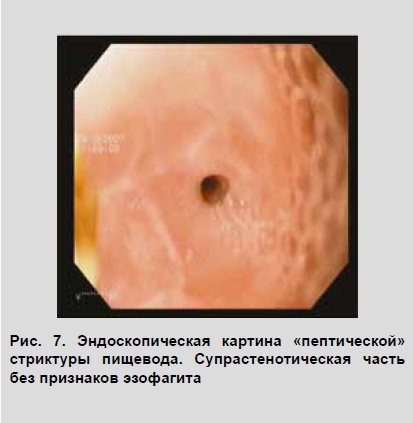 Strictura peeptică a esofagului, diagnosticul și tratamentul