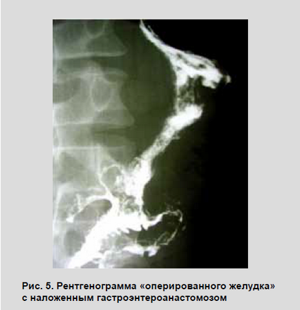 Strictura peeptică a esofagului, diagnosticul și tratamentul