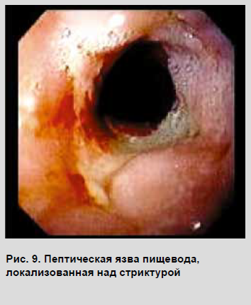 Strictura peeptică a esofagului, diagnosticul și tratamentul