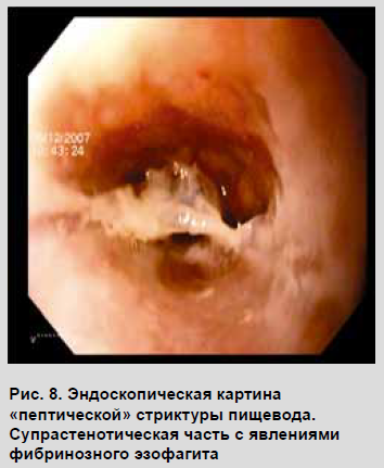 Strictura peeptică a esofagului, diagnosticul și tratamentul