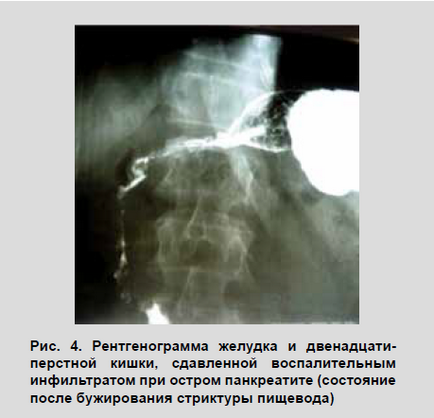 Strictura peeptică a esofagului, diagnosticul și tratamentul