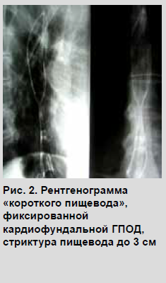 Strictura peeptică a esofagului, diagnosticul și tratamentul