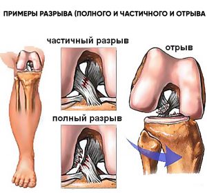 Anterioară ligament cruciat al simptomelor articulației genunchiului, tratament, cauze