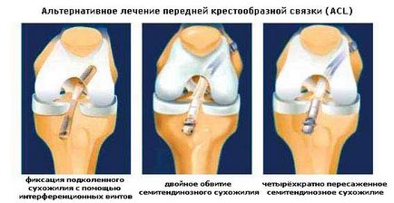 Передня хрестоподібна зв'язка колінного суглоба симптоми, лікування, причини