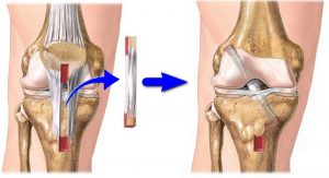 Anterioară ligament cruciat al simptomelor articulației genunchiului, tratament, cauze