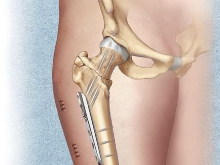 csípőtáji törés utáni rehabilitáció műtét otthon, a tünetek az idősek