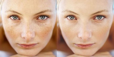 Tipuri de pigmentare a pielii, cauze, tratament