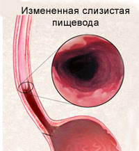 Barrett esophagus - prețurile pentru tratamentul, simptomele și diagnosticul esofagului barretului în 