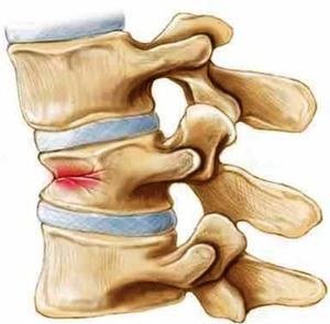 Помощ с компресия фрактури на лумбалните прешлени, симптоми и лечение