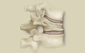 Ajutați la comprimarea coloanei vertebrale lombare, simptome și tratament