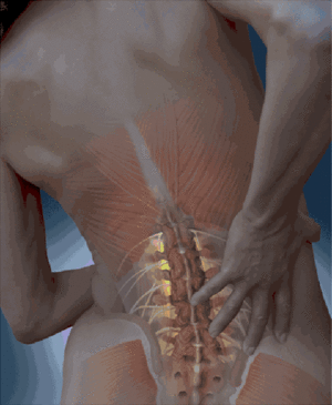 Допомога при компресійному переломі хребта поперекового відділу, симптоми і лікування