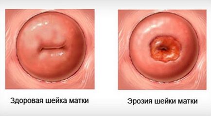 Cauzele și tratamentul eroziunii cervicale