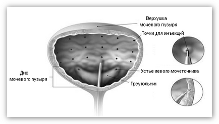 Aplicația botox