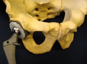Utilizarea cizmei de degenerare pentru fractura gâtului coapsei, rol, specie, tratament - vii sănătoși