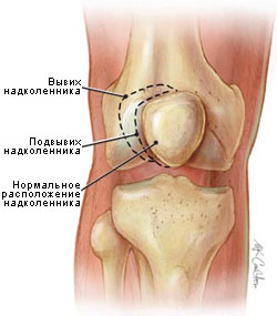 Dislocarea obișnuită și congenitală a patellei